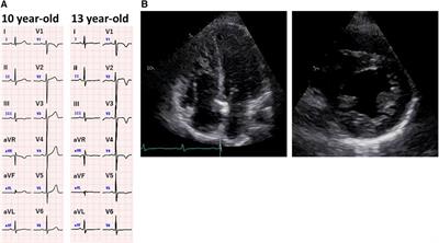 A case report of a child with pulmonary hypertension associated with SARS-CoV-2 infection